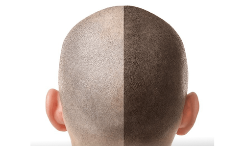 scalp tattooing before after mississauga oakville